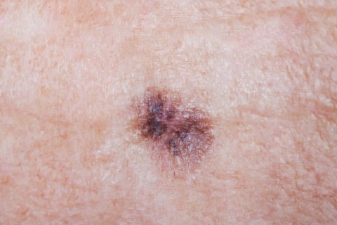 Dezembro Laranja reforça prevenção e alerta para diagnóstico precoce do câncer de pele em Minas