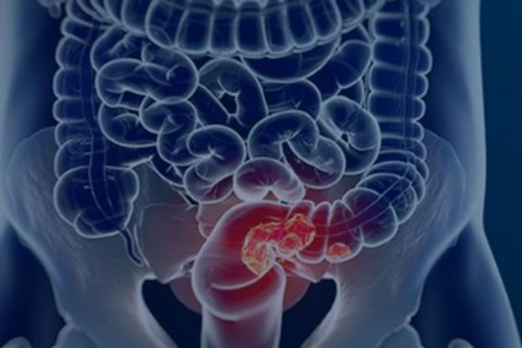 Rastreamento para câncer colorretal pode ser implementado no SUS